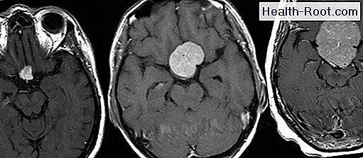 meningioma la malattia i sintomi il trattamento 2021