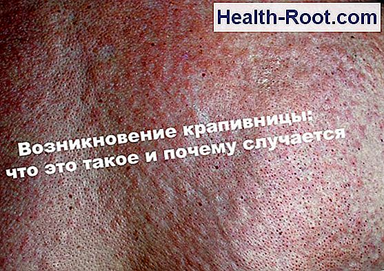 Akut urticaria akut urticaria Betegség A Tünetek A Kezelés 2023