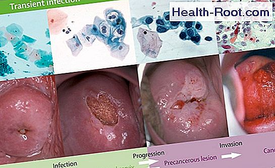 Test for HPV (Human Papillomavirus) 🏥 Disease, Symptoms