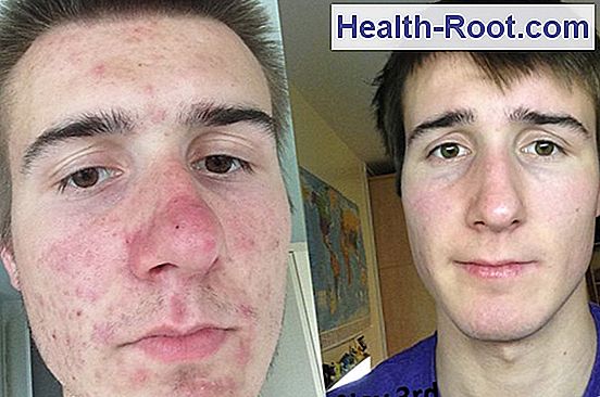 Isotretinoin 