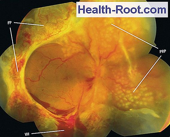 Bone Marrow Examination Disease Symptoms Treatment 2022