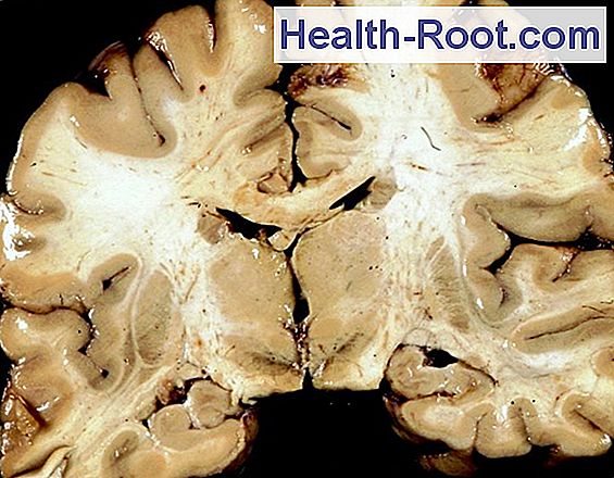 10+ Creutzfeldt-Jakob Disease Treatment Gif