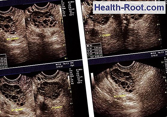 rare-and-irregular-periods-disease-symptoms-treatment-2023