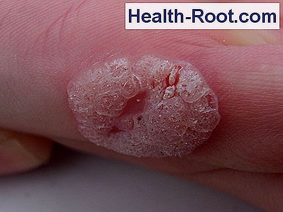 Warts (foot warts and warts on hands) 🏥 Disease, Symptoms, Treatment. 2024