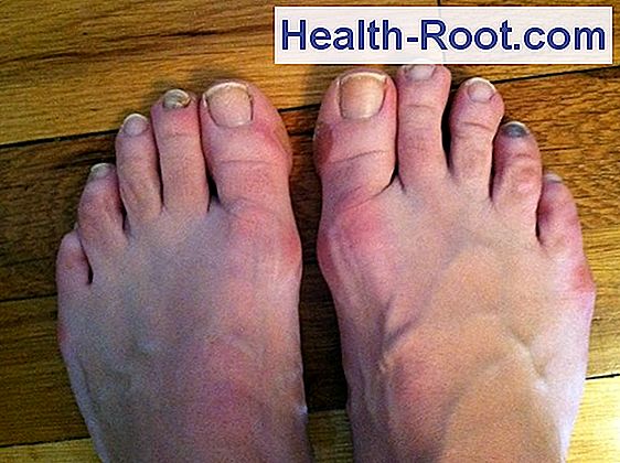 Could it be because of nail fungus that my toenails smell? 🏥 Disease,  Symptoms, Treatment. 2023