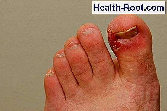 My Big Toe Nail Hurts Very Much Disease Symptoms Treatment 2022