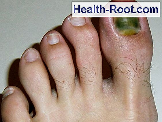 my-big-toe-nails-are-yellow-and-hard-disease-symptoms-treatment-2023