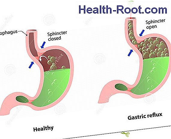 Heartburn Disease Symptoms Treatment 2024