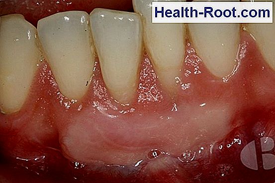 absceso dental absceso dental