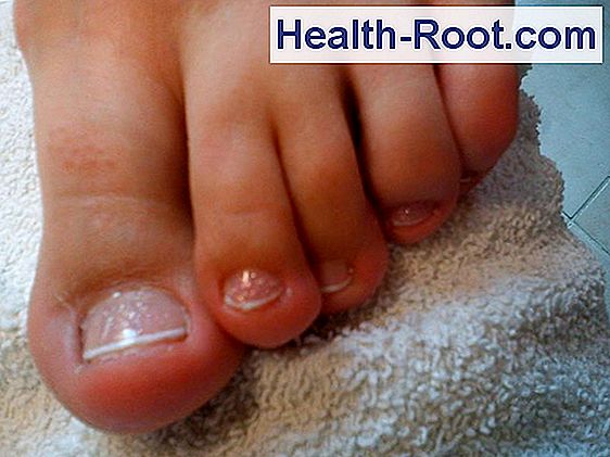 nail gomba fertőző betegség vajon a köröm gombás fájt a lába