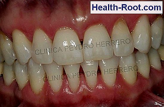 Periodontit semptomları çok ciddi Periodontit semptomları çok ciddi